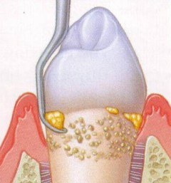 non-surgical dental treatment
