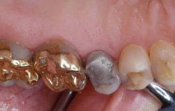 restore a broken tooth