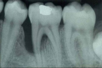 dental bone loss